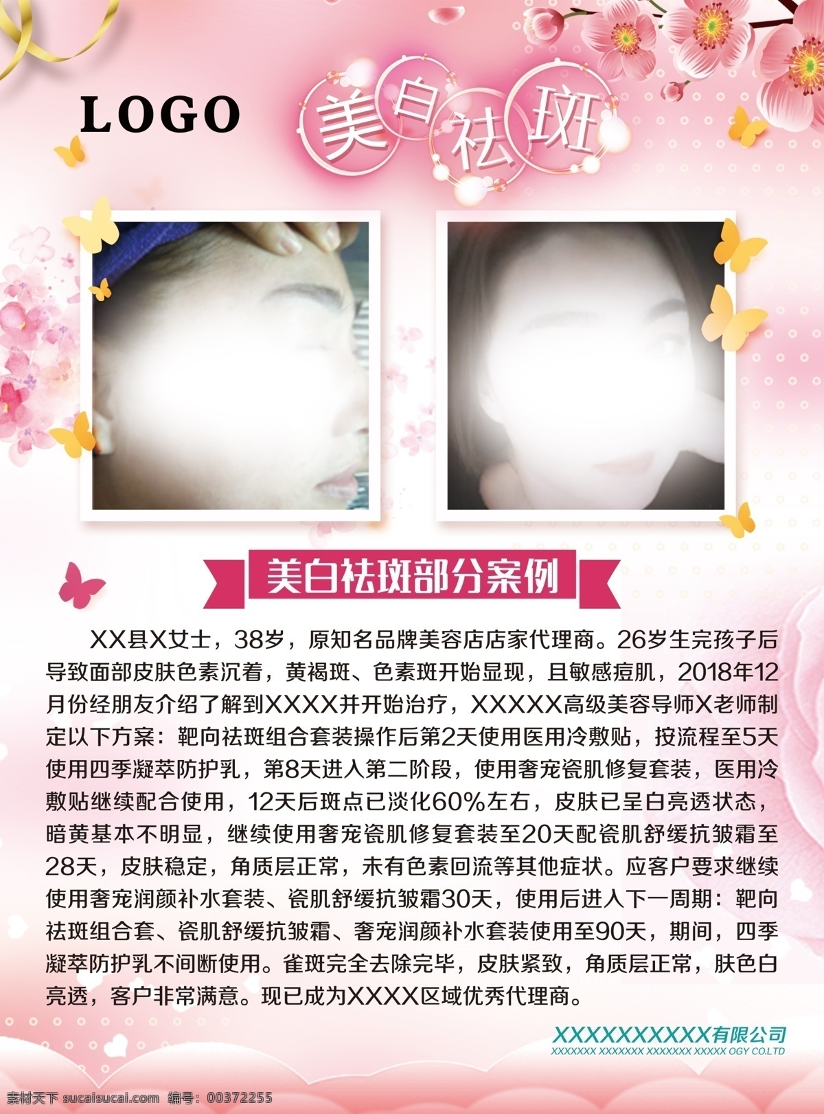 美白祛斑圖片 美白祛斑 美容 部分案例 抗皺霜 補水 黃褐斑 雀斑 代理商 分層
