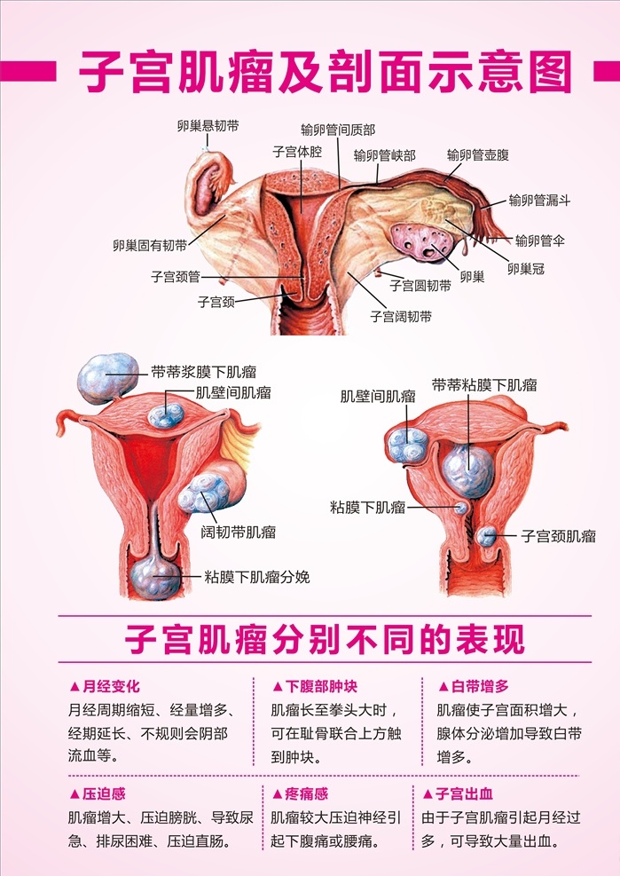 子宫肌瘤 示意图 子宫肌瘤表现 子宫肌瘤图 肌瘤 子宫 医院妇科