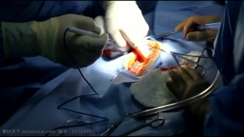 人物 手术 视频 人物视频素材 手术视频 医生 医院视频 手术室 实拍视频 视频素材