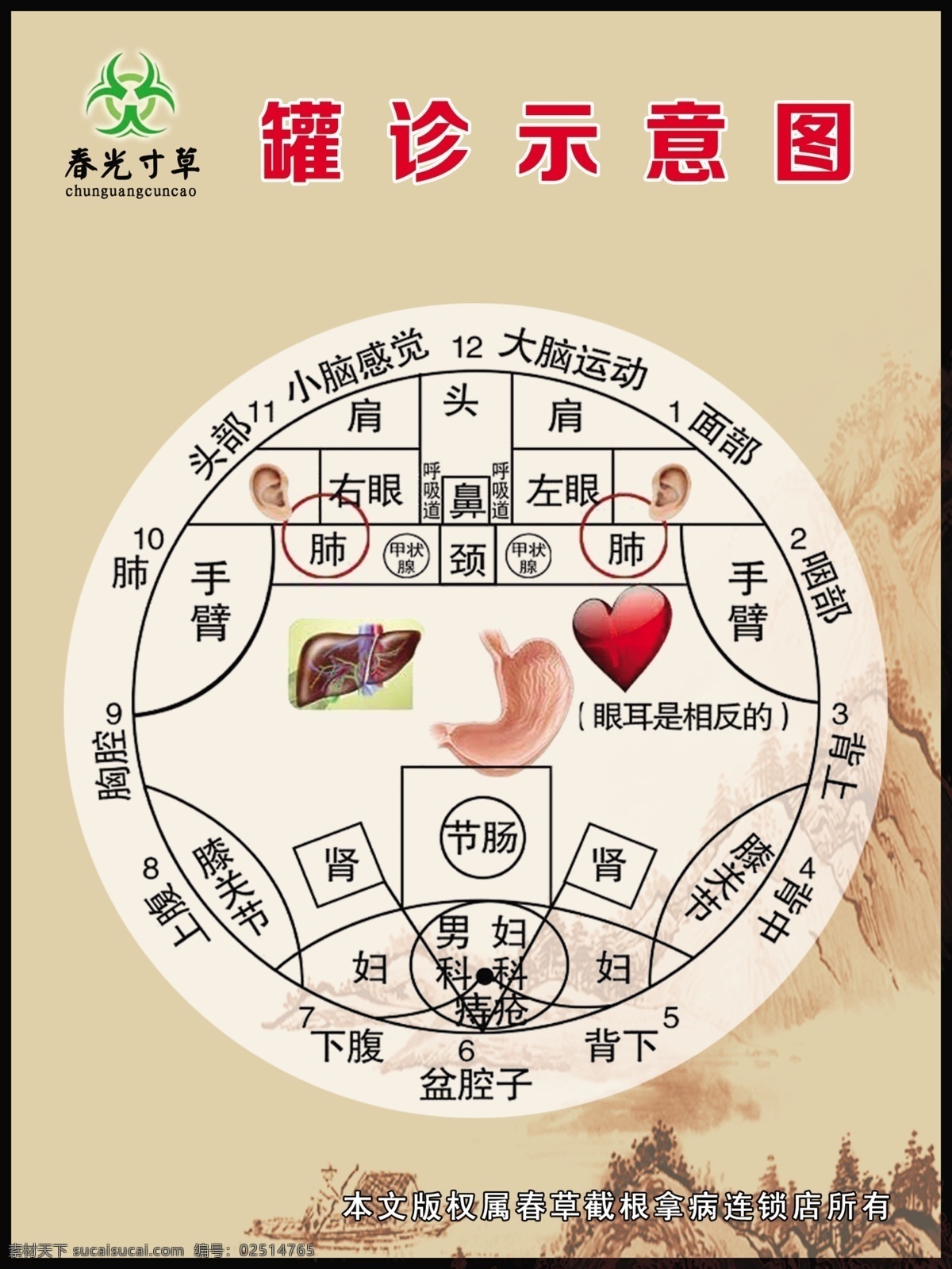 春光寸草罐诊 春光寸草 罐诊 示意图 理疗 截根拿病
