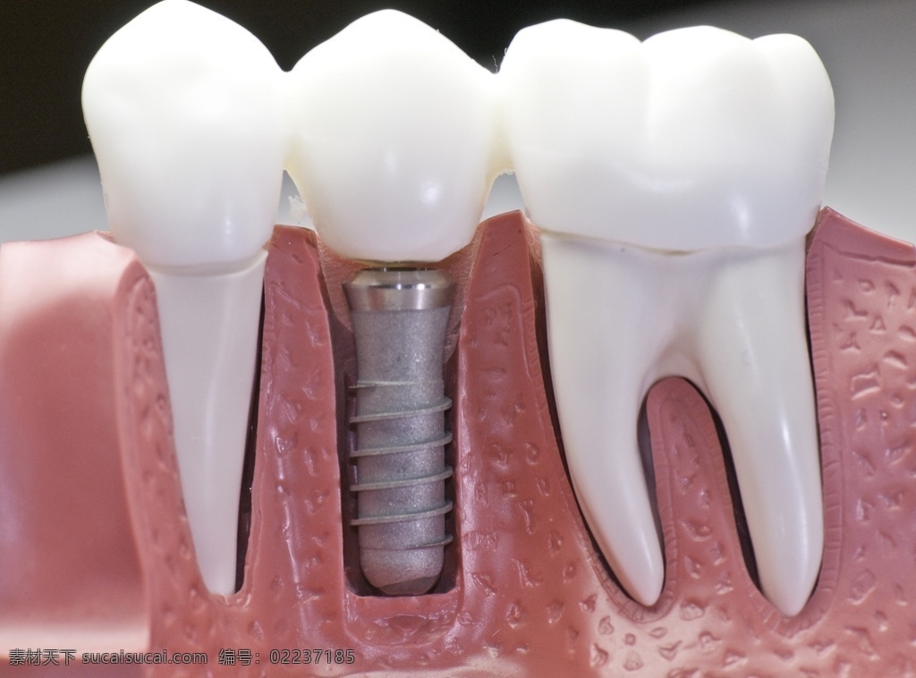 牙齿模型 牙模 牙龈 牙龄 牙科 牙医 口腔护理
