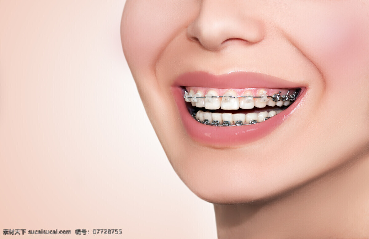 牙箍 牙套 牙线 洁白牙齿 牙齿矫正 口腔护理 牙科 牙模型 生活百科