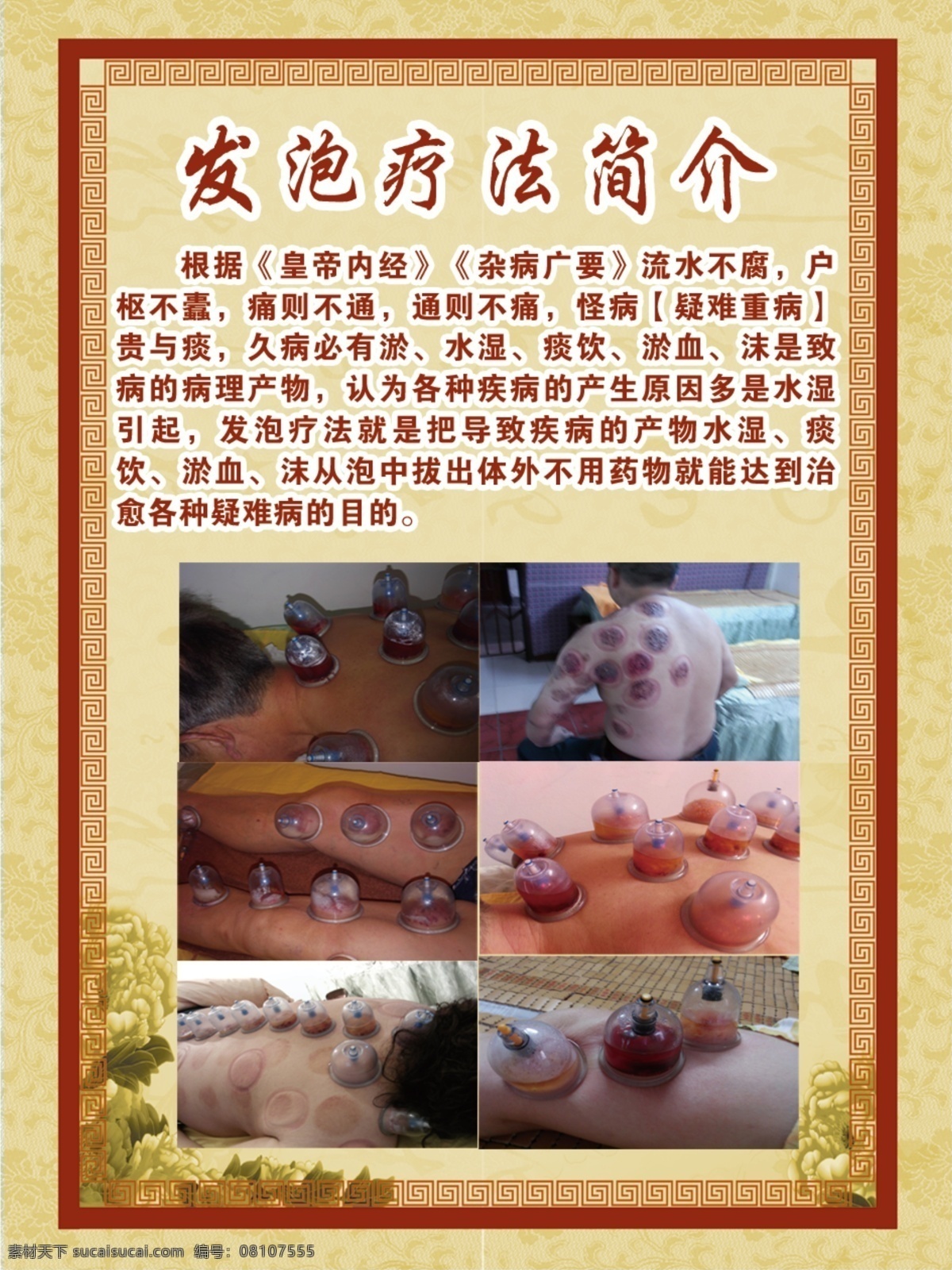 发泡疗法简介 导致 疾病 产物 水 湿 痰饮 淤血 沫 泡 中 拔出 体外 不用药物 治愈 各种 疑难病 目的 黄色