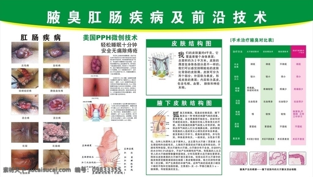 腋臭肛肠挂图 腋臭肛肠 医院挂图 肛肠疾病 pph 微创 技术