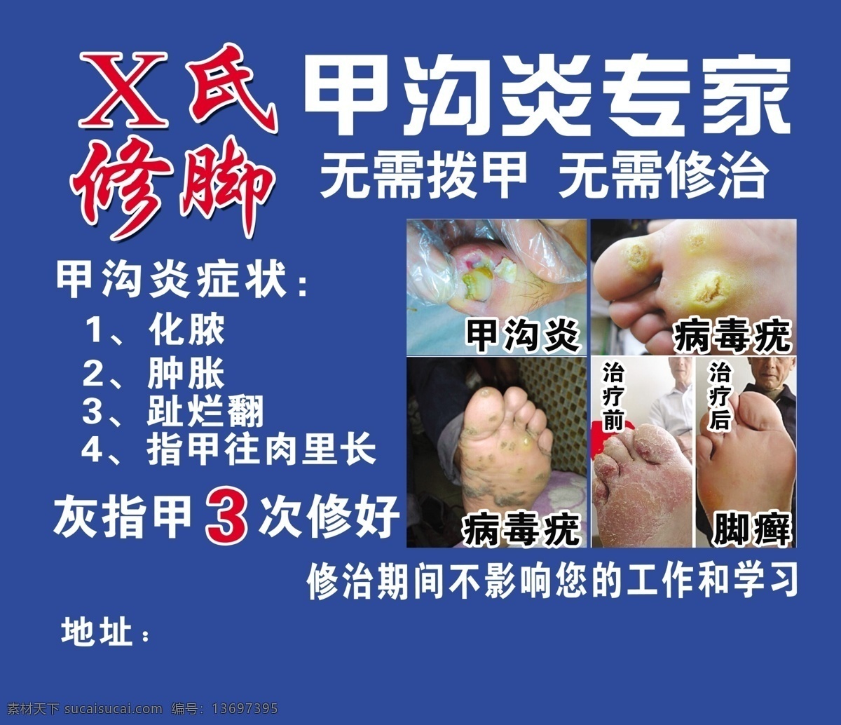 修脚 海报 蓝色 灰指甲